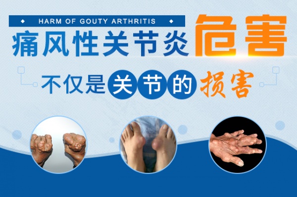 痛风能传染给别人吗